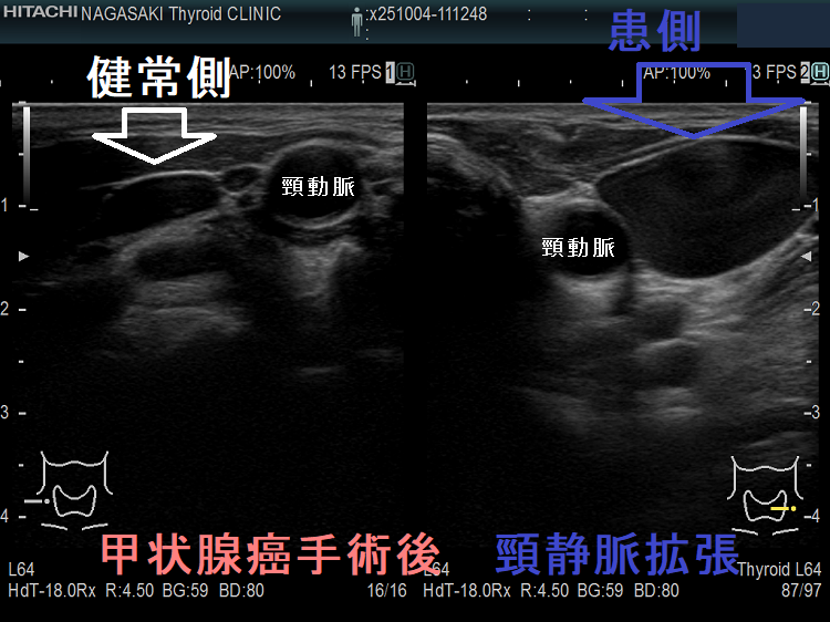 甲状腺癌手術後 頸静脈拡張 左右比較 甲状腺癌手術後 頸静脈拡張 左右比較