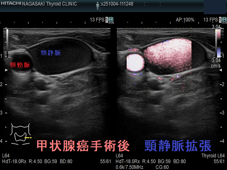 甲状腺癌手術後 頸静脈拡張 患側 甲状腺癌手術後 頸静脈拡張 患側