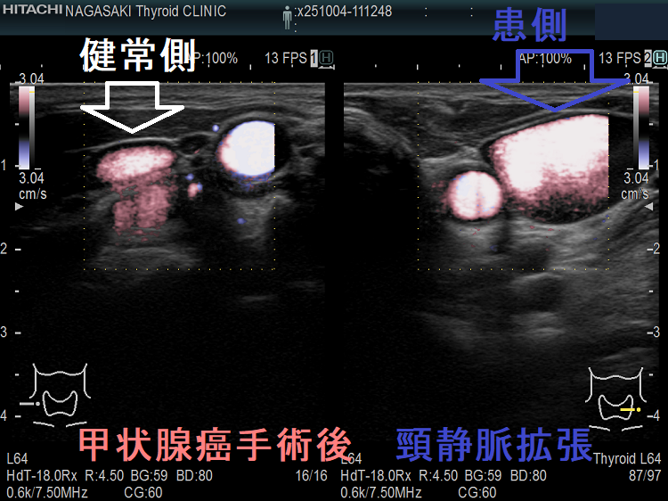 甲状腺癌手術後 頸静脈拡張 左右比較 ドプラーモード 甲状腺癌手術後 頸静脈拡張 左右比較 ドプラーモード