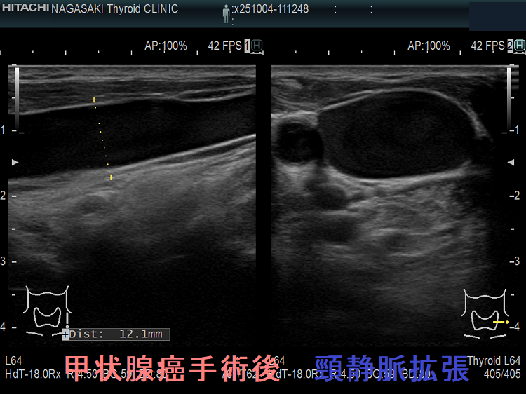 甲状腺癌手術後 頸静脈拡張 患側2 甲状腺癌手術後 頸静脈拡張 患側2
