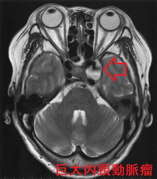 巨大内頸動脈瘤 単純MRI T2 強調像 巨大内頸動脈瘤 単純MRI T2 強調像