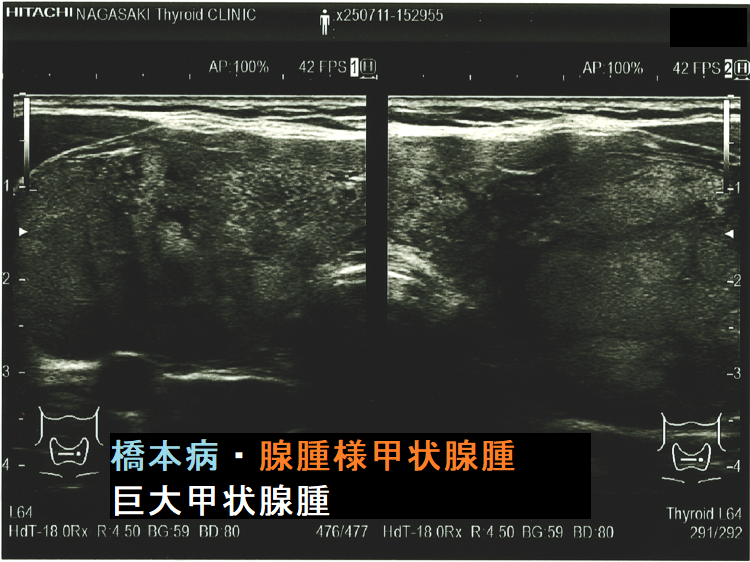 橋本病・腺腫様甲状腫 巨大甲状腺腫 エコー(水平断) 橋本病・腺腫様甲状腫 巨大甲状腺腫 エコー(水平断)