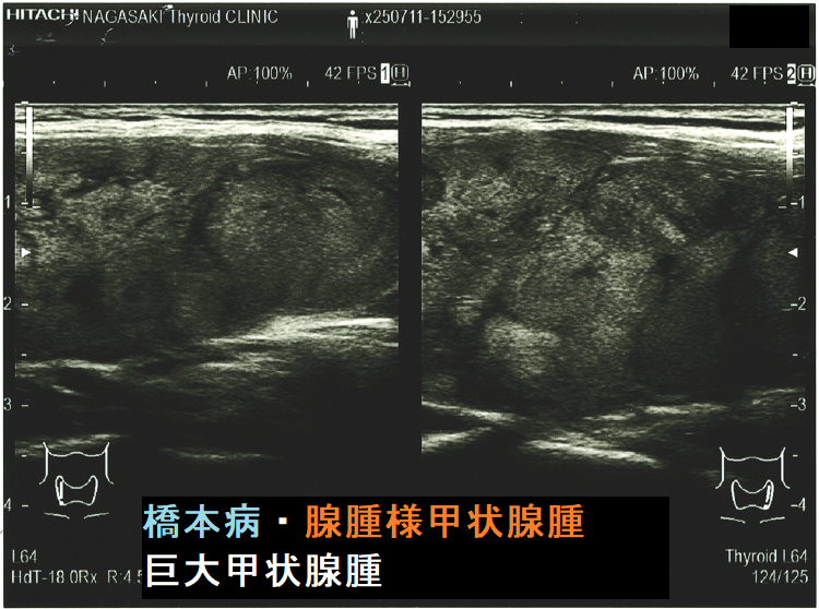 橋本病・腺腫様甲状腫による巨大甲状腺腫(矢状断) 橋本病・腺腫様甲状腫による巨大甲状腺腫(矢状断)