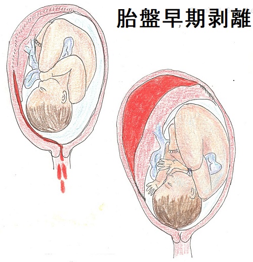 胎盤早期剥離 胎盤早期剥離