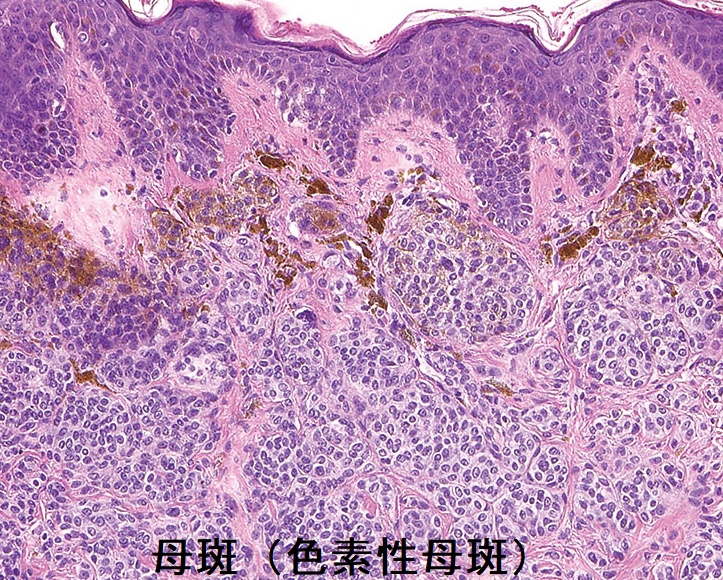 母斑(色素性母斑)組織像 母斑(色素性母斑)組織像