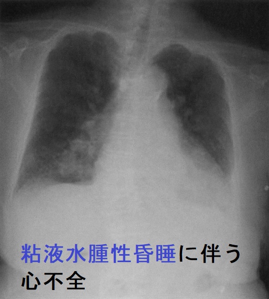 粘液水腫性昏睡に伴う心不全 粘液水腫性昏睡に伴う心不全