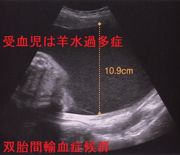 双胎間輸血症候群 超音波像(第1児の最大羊水深度) 双胎間輸血症候群 超音波像(第1児の最大羊水深度)