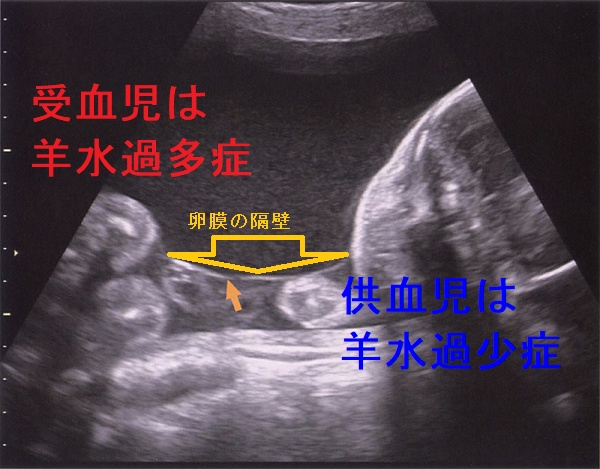 双胎間輸血症候群 超音波像(両児間の隔壁) 双胎間輸血症候群 超音波像(両児間の隔壁)