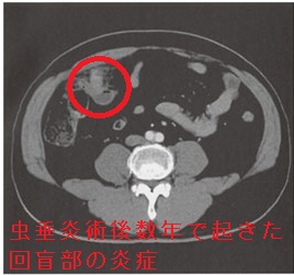 虫垂炎切除手術後数年で回盲部に炎症→腹膜炎 腹部造影CT 虫垂炎切除手術後数年で回盲部に炎症→腹膜炎 腹部造影CT