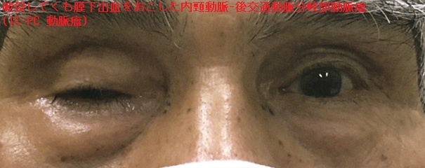 破裂して、くも膜下出血をおこした内頸動脈-後交通動脈分岐部動脈瘤(IC-PC 動脈瘤) 破裂して、くも膜下出血をおこした内頸動脈-後交通動脈分岐部動脈瘤(IC-PC 動脈瘤)1