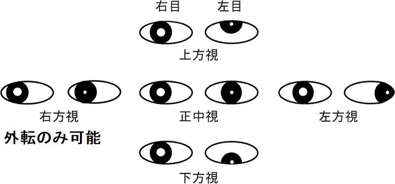 破裂して、くも膜下出血をおこした内頸動脈-後交通動脈分岐部動脈瘤(IC-PC 動脈瘤)動眼神経麻痺 破裂して、くも膜下出血をおこした内頸動脈-後交通動脈分岐部動脈瘤(IC-PC 動脈瘤)動眼神経麻痺