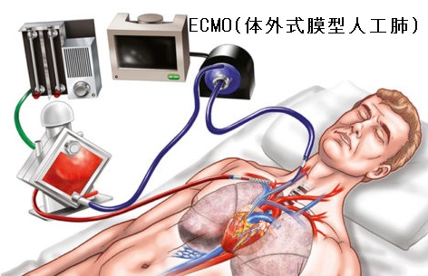 ECMO(体外式膜型人工肺) ECMO(体外式膜型人工肺)