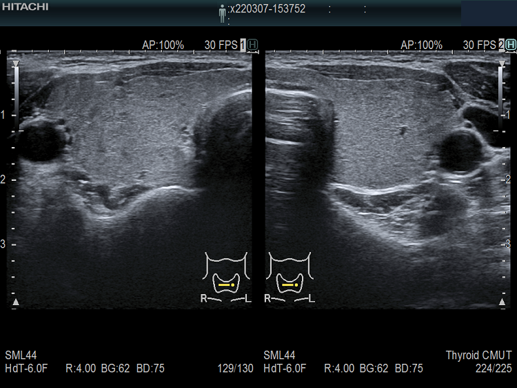 遺伝性・先天性甲状腺ホルモン合成障害 超音波(エコー)画像 遺伝性・先天性甲状腺ホルモン合成障害 超音波(エコー)画像