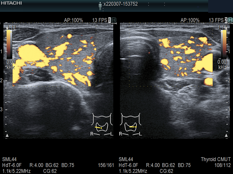 遺伝性・先天性甲状腺ホルモン合成障害 超音波(エコー)画像 ドプラー 遺伝性・先天性甲状腺ホルモン合成障害 超音波(エコー)画像 ドプラー