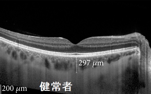 健常者 前眼部光干渉断層計(AS-OCT) 健常者 前眼部光干渉断層計(AS-OCT)