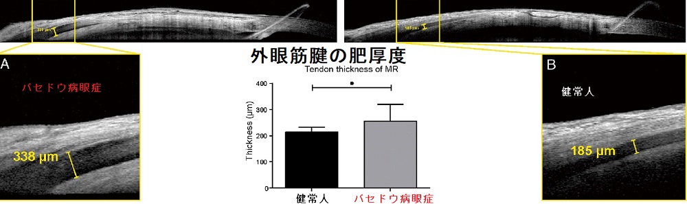 外眼筋腱の肥厚度 前眼部光干渉断層計(AS-OCT) 外眼筋腱の肥厚度 前眼部光干渉断層計(AS-OCT)