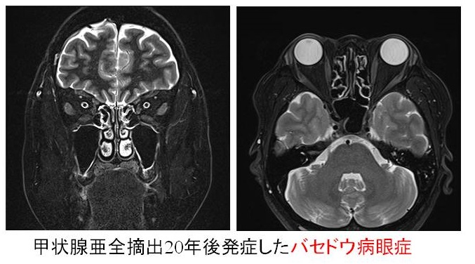 甲状腺亜全摘出20年後発症したバセドウ病眼症 甲状腺亜全摘出20年後発症したバセドウ病眼症