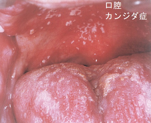 口腔カンジダ症 口腔カンジダ症