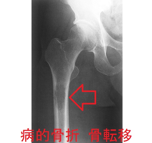 病的骨折 骨転移 病的骨折 骨転移
