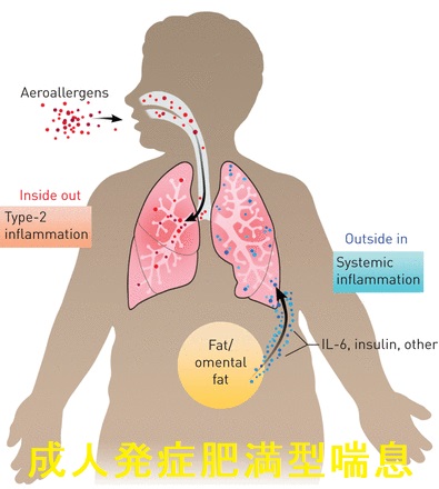成人発症肥満型喘息 成人発症肥満型喘息