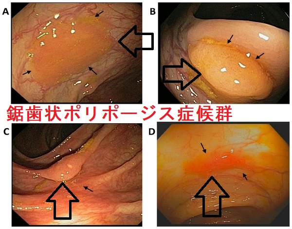鋸歯状ポリ ポージス症候群 鋸歯状ポリ ポージス症候群PLoS One. 2014 Feb 12;9(2)e88367.