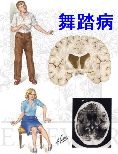 甲状腺機能亢進症/バセドウ病の舞踏病様の不随意運動 甲状腺機能亢進症/バセドウ病の舞踏病様の不随意運動