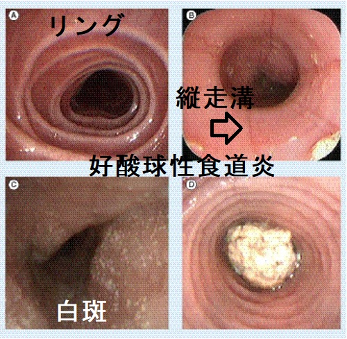 好酸球性食道炎 好酸球性食道炎