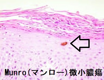 Munro(マンロー)微小膿瘍 Munro(マンロー)微小膿瘍