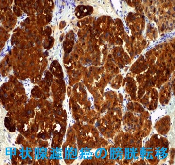 甲状腺濾胞癌の膀胱転移 甲状腺濾胞癌の膀胱転移