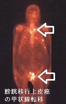 膀胱移行上皮癌の甲状腺転移 膀胱移行上皮癌の甲状腺転移