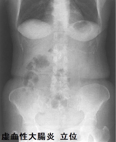 虚血性大腸炎 立位 虚血性大腸炎 立位