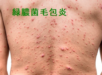 緑膿菌毛包炎 緑膿菌毛包炎