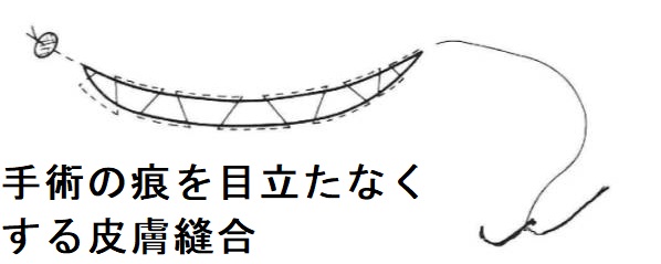 手術の痕を目立たなくする皮膚縫合 手術の痕を目立たなくする皮膚縫合