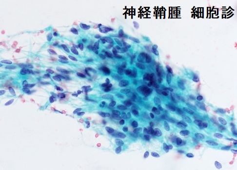 神経鞘腫 細胞診 神経鞘腫 細胞診