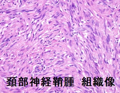 頚部神経鞘腫 組織像 頚部神経鞘腫 組織像