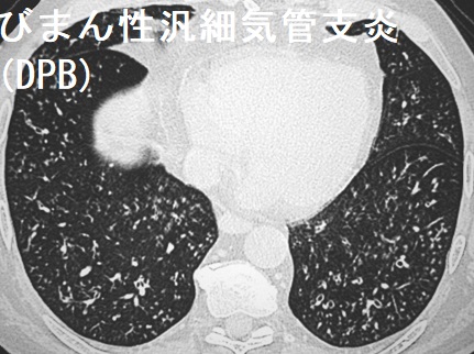 びまん性汎細気管支炎(DPB) びまん性汎細気管支炎(DPB)