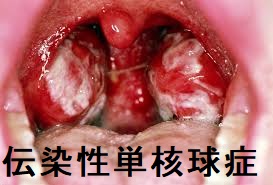 伝染性単核球症 扁桃 伝染性単核球症 扁桃