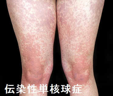 伝染性単核球症 紅斑 伝染性単核球症 紅斑