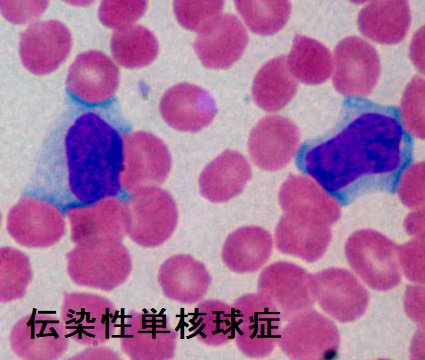 伝染性単核球症 異型リンパ球 伝染性単核球症 異型リンパ球