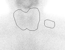 無痛性甲状腺炎の99mTc(テクネチウム)シンチグラフィー 無痛性甲状腺炎の99mTc(テクネチウム)シンチグラフィー
