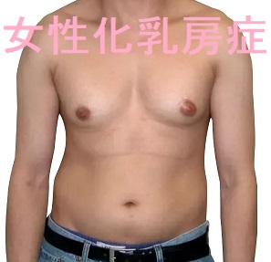 女性化乳房症 女性化乳房症