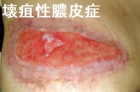 壊疽性膿皮症 バセドウ病 壊疽性膿皮症 バセドウ病
