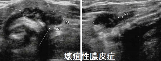 壊疽性膿皮症 甲状腺乳頭癌全摘出後 壊疽性膿皮症 甲状腺乳頭癌全摘出後
