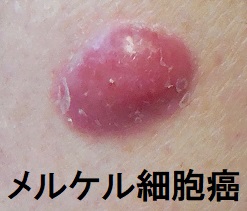 メルケル細胞癌 メルケル細胞癌