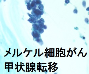 メルケル細胞がん 甲状腺転移 メルケル細胞がん 甲状腺転移