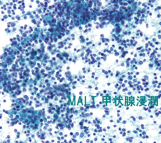 MALT 甲状腺浸潤 穿刺細胞診 MALT 甲状腺浸潤 穿刺細胞診