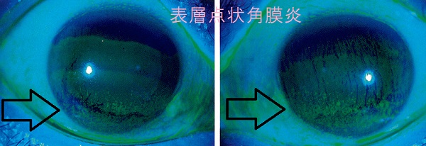 ドライアイによる表層点状角膜炎 ドライアイによる表層点状角膜炎