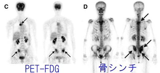 甲状腺分化癌(乳頭癌・濾胞癌)骨転移 骨シンチ PET-FDG 甲状腺分化癌(乳頭癌・濾胞癌)骨転移 骨シンチ PET-FDG