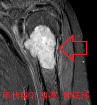 甲状腺乳頭癌 骨転移 MRI star画像 甲状腺乳頭癌 骨転移 MRI star画像