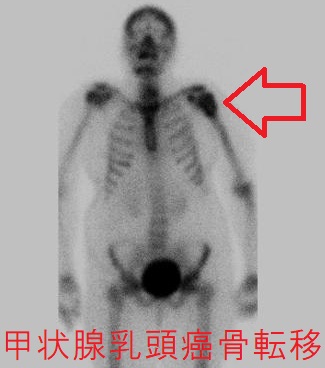 甲状腺乳頭癌 骨転移 PET-FDG 甲状腺乳頭癌 骨転移 PET-FDG